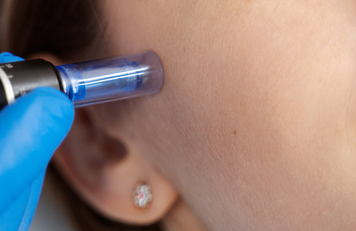 ダーマペン施術 画像