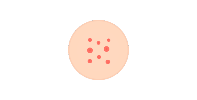 ニキビ跡・クレーター改善 画像